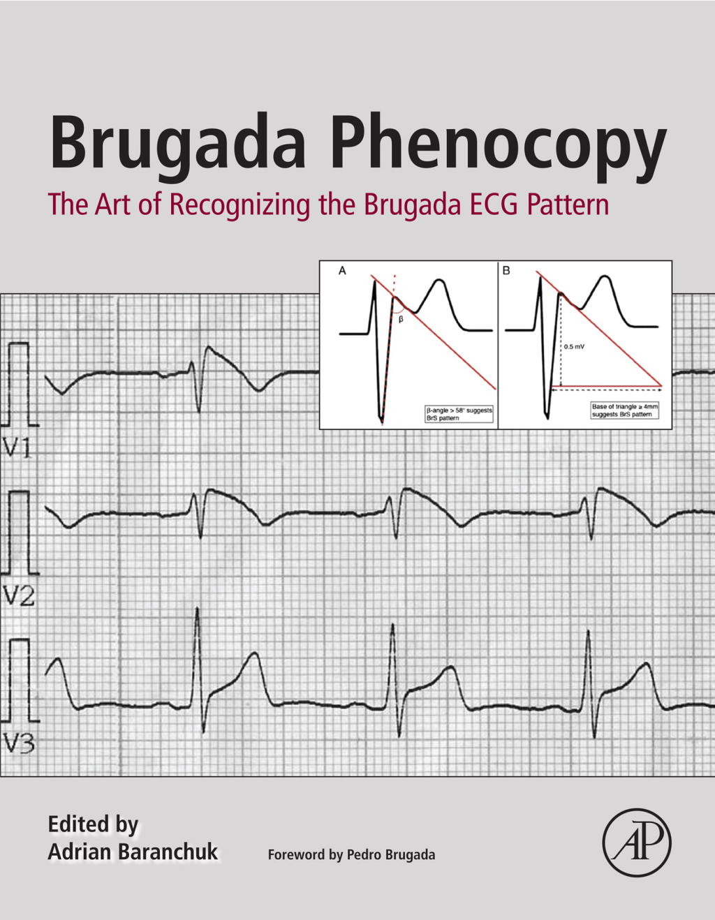 Brugada Phenocopy The Art of Recognizing the Brugada ECG Pattern 